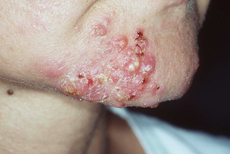 Pyoderma Faciale Rosacea Fulminans