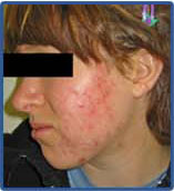 Pyoderma Faciale Rosacea Fulminans