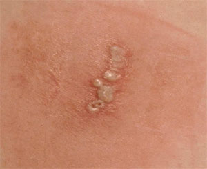 Herpes Simplex 1 Genital Transmission