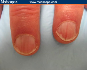 Malignant Melanoma Fingernail