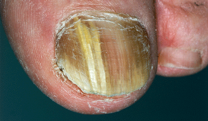 Malignant Melanoma Fingernail