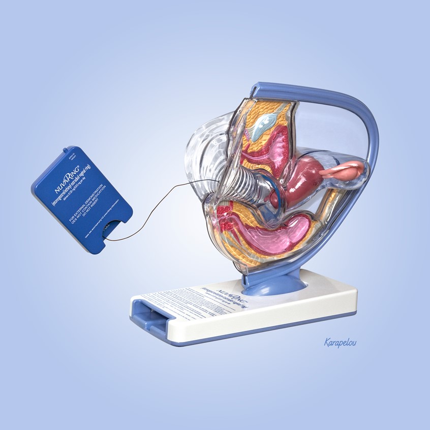 Nuvaring Placement Picture