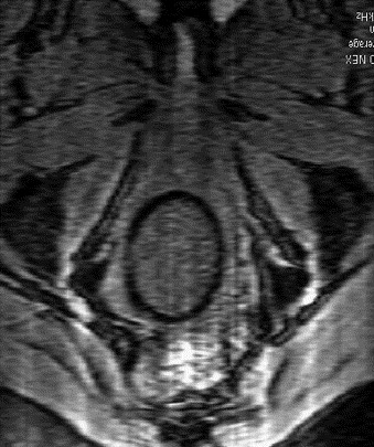 Nuvaring Placement Picture