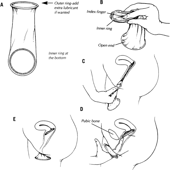 Nuvaring Placement Picture